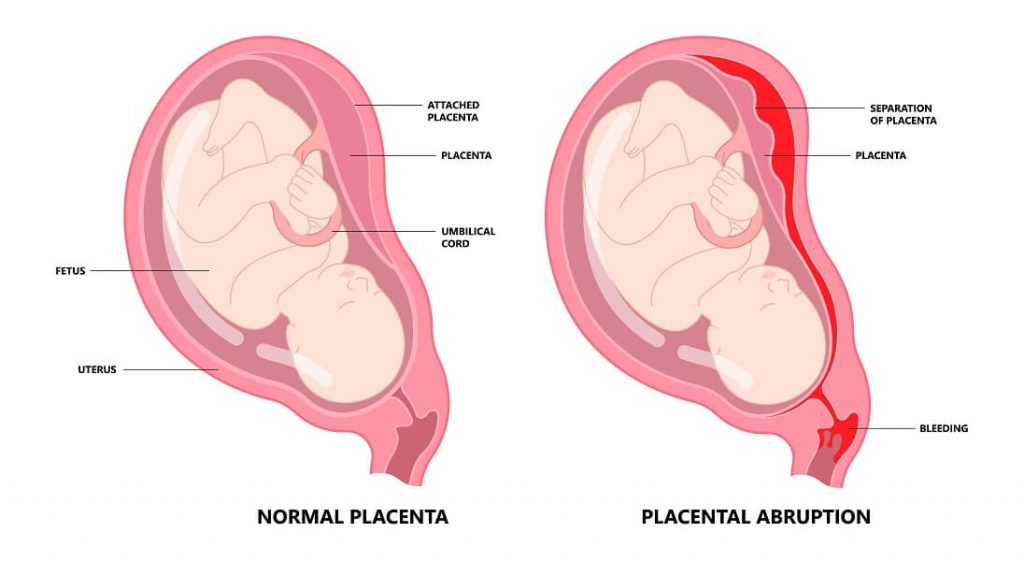 pendarahan ketika mengandung - Placenta Abruptio