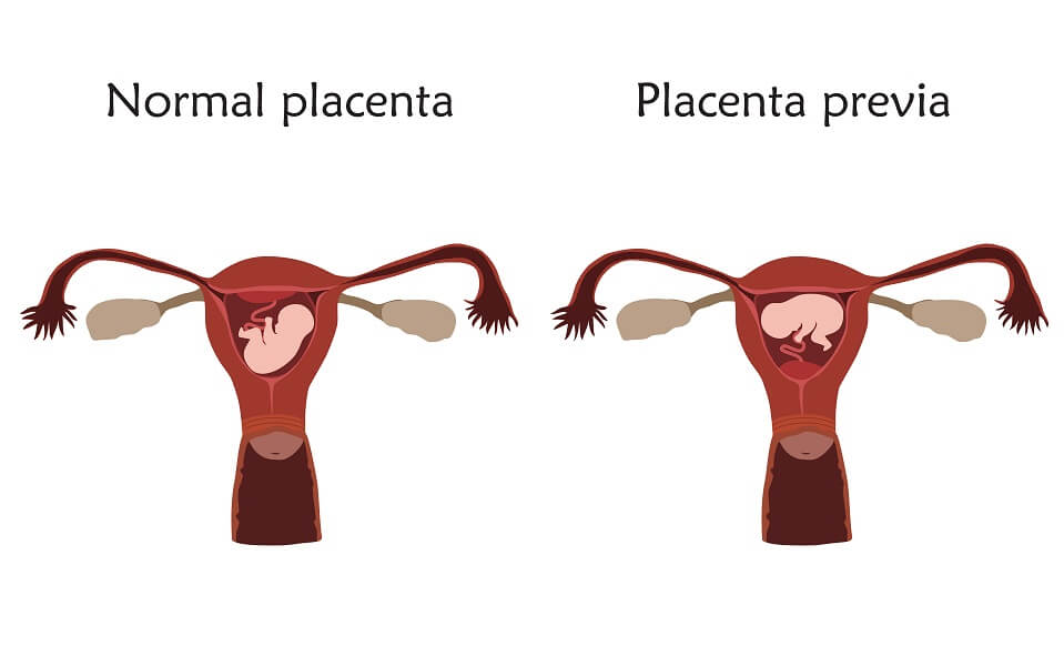 pendarahan ketika mengandung - Placenta Previa