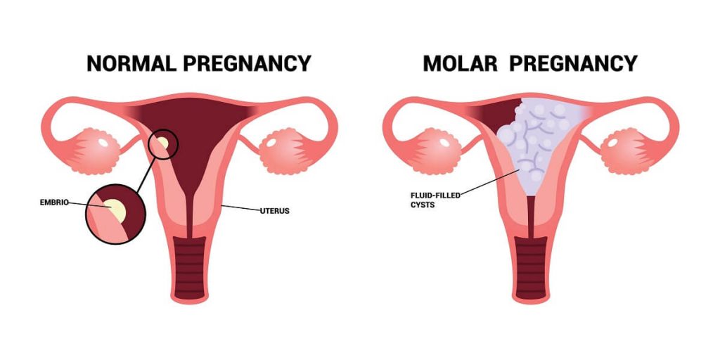 pendarahan ketika mengandung - molar pregnancy atau kehamilan anggur