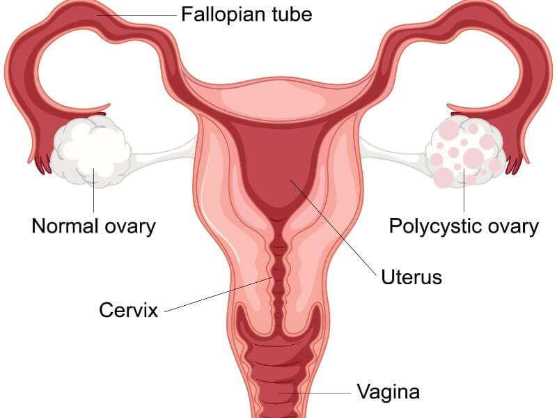 pcos