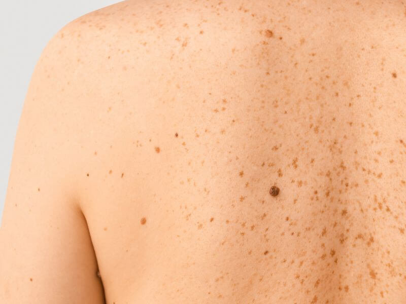 kanser melanoma atau kulit 