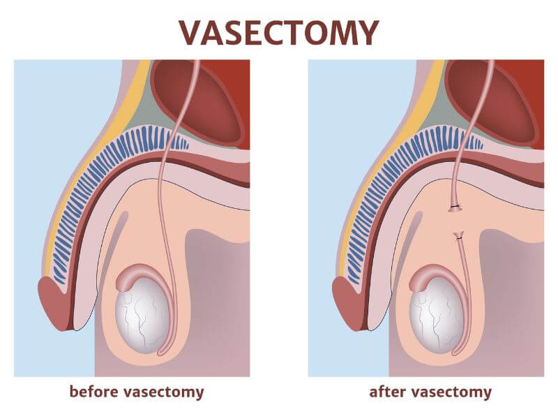 vasectomy