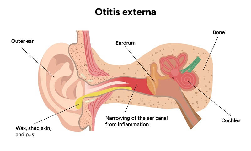 ear irrigation